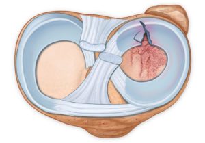 A meniscus tear